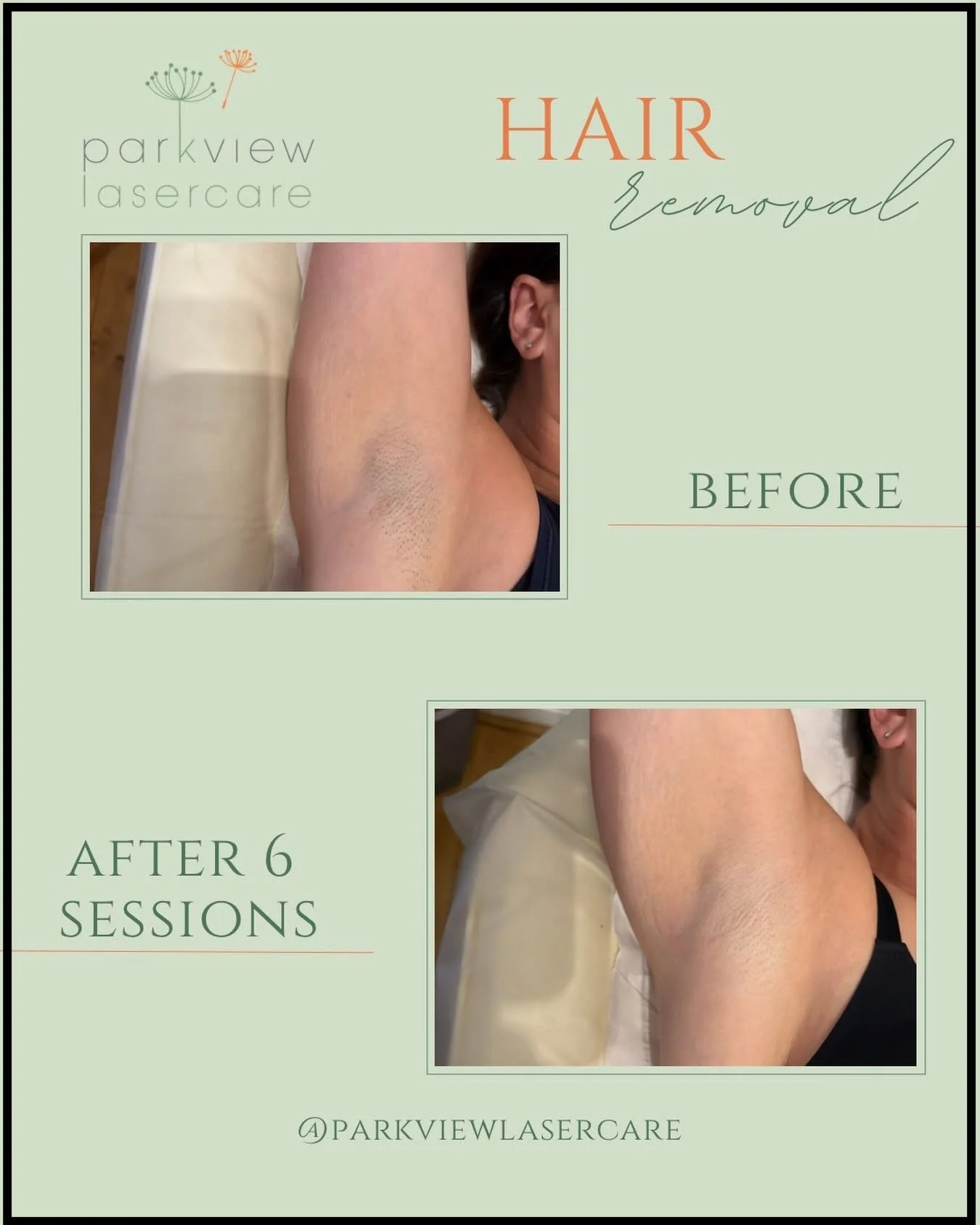 Comparison of a person's underarm before and after six laser hair removal sessions at Parkview Lasercare, showing reduction in hair growth.