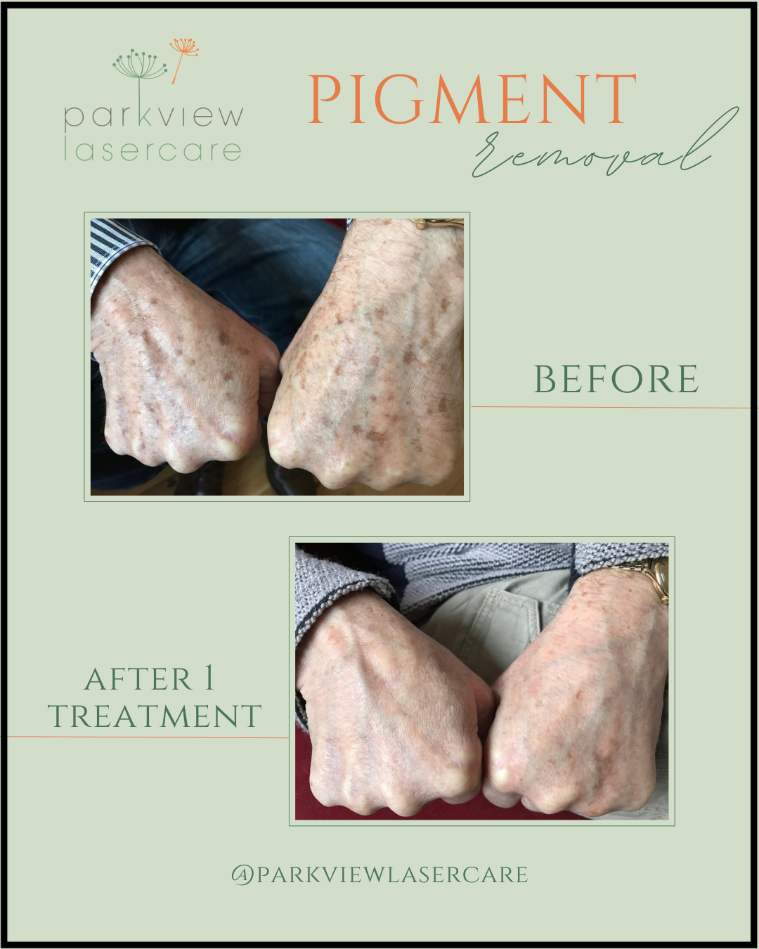 Before and after images of the back of a man's hands showing successful removal of skin pigmentation after one treatment at Parkview Lasercare.
