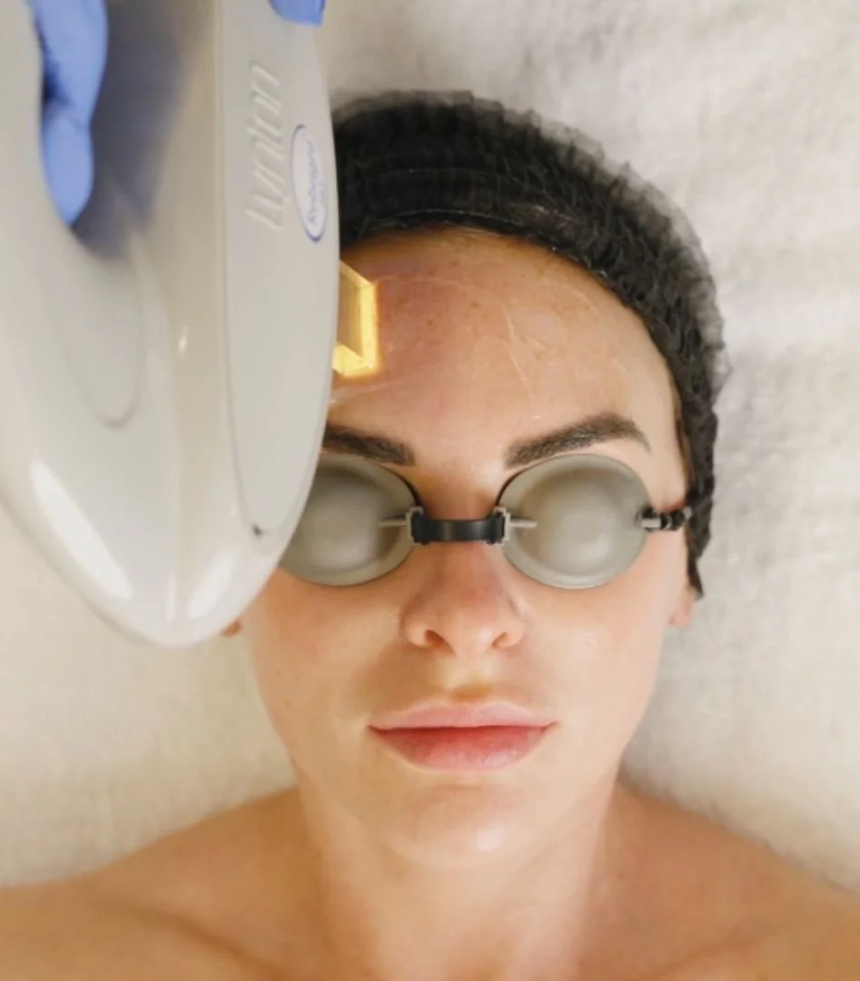 A head image of a female client receiving Intense Pulsed Light treatment for acne on her face.