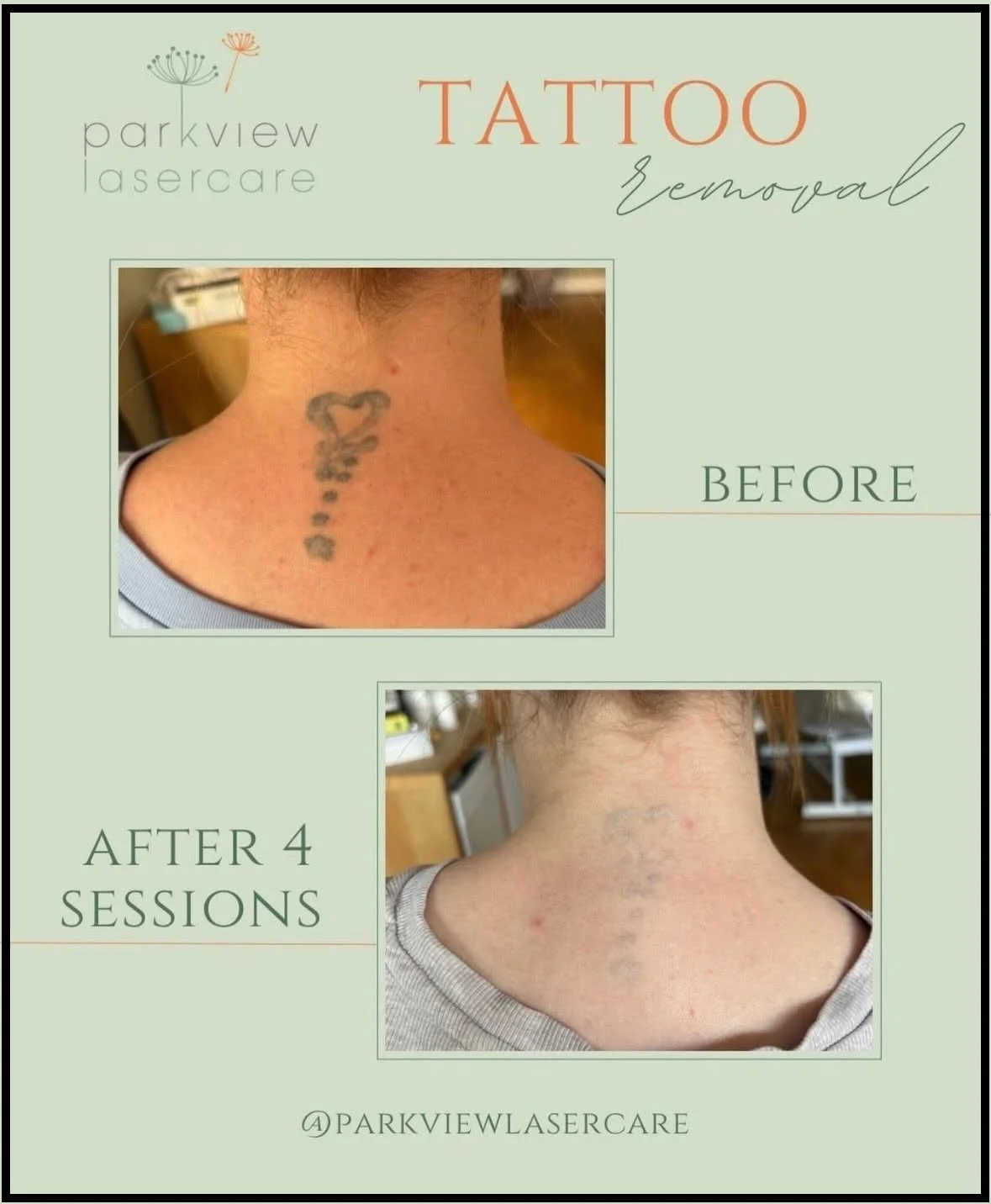 Before and after images showing tattoo removal on the back of a person's neck, after four sessions of treatment at Parkview Lasercare.