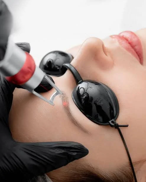 client receiving eyebrow removal treatment using lynton laser