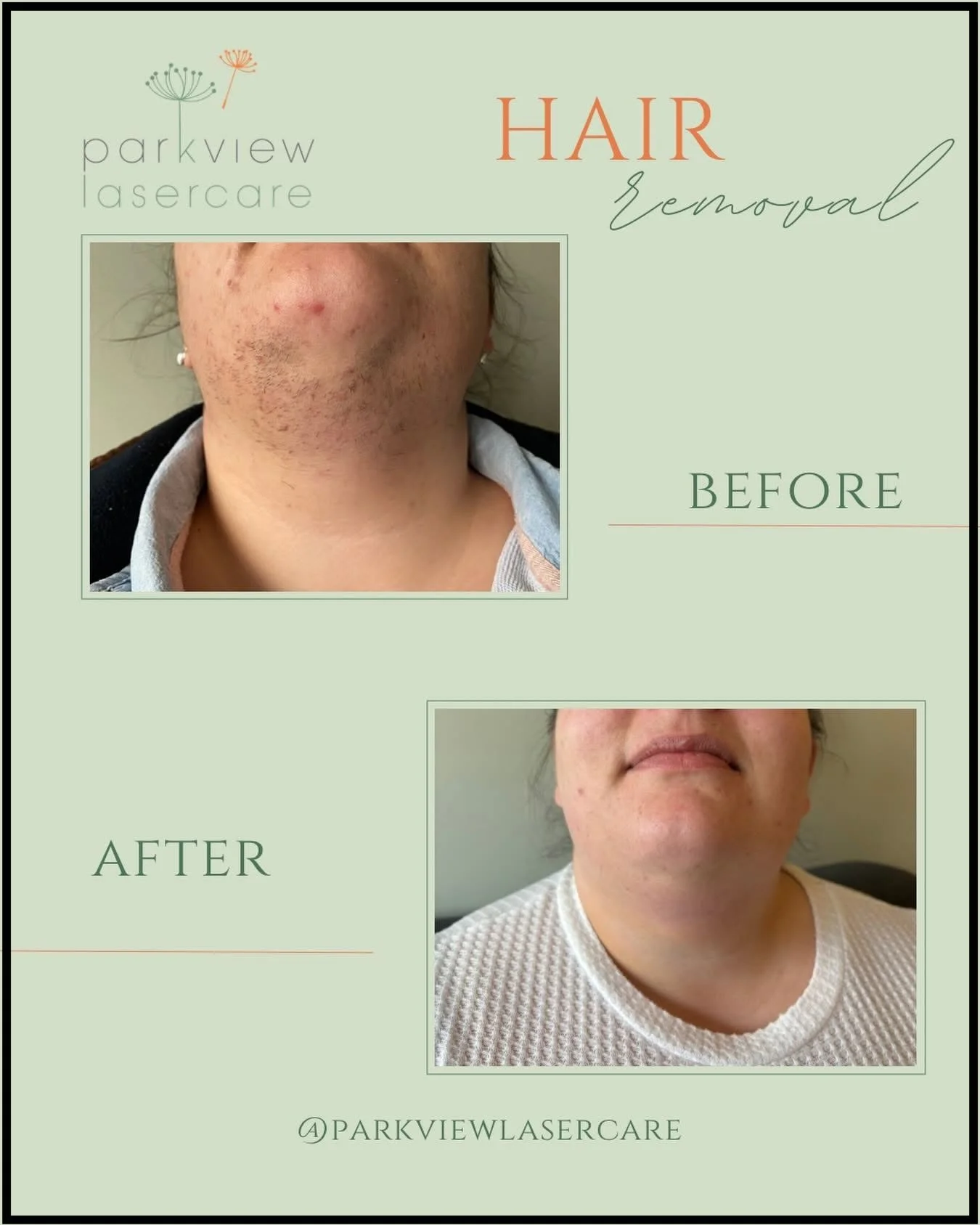 Before and after photos showing hair removal on the chin area with treatment at Parkview Laser Care.