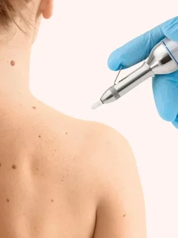 client with skin conditions being addressed with clinician holding cryoiq pen