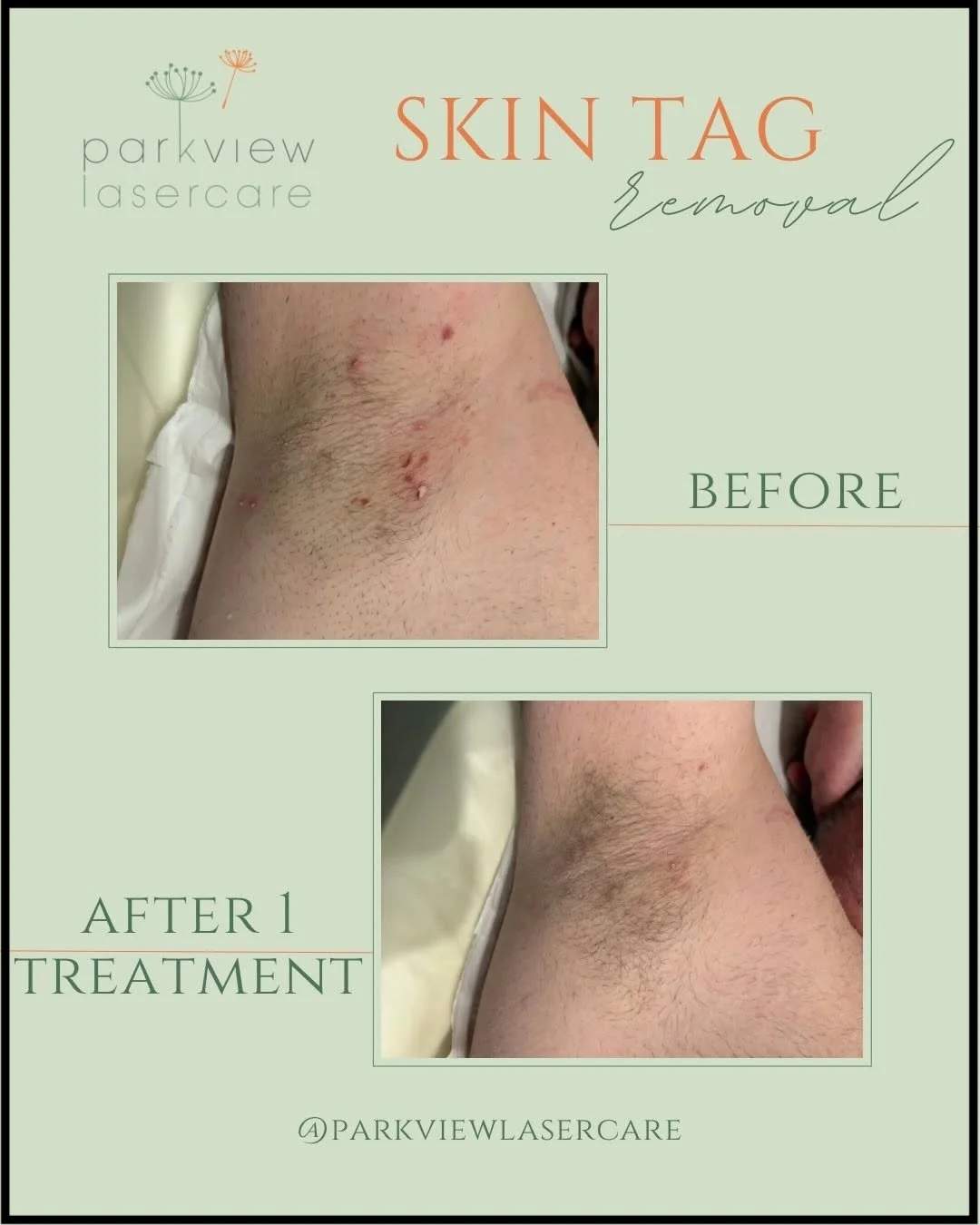 Before and after images of a person's underarm showing successful skin tag removal treatment at Parkview Lasercare.