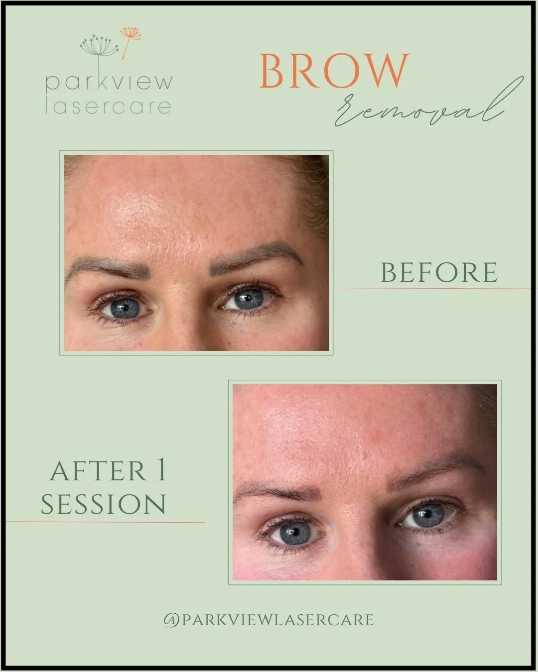 Before and after images showing the results of eyebrow removal treatment from Parkview Laser Care, with the 'before' image at the top highlighting visible eyebrow tattoo ink and the 'after' photo showing a significant reduction in ink.
