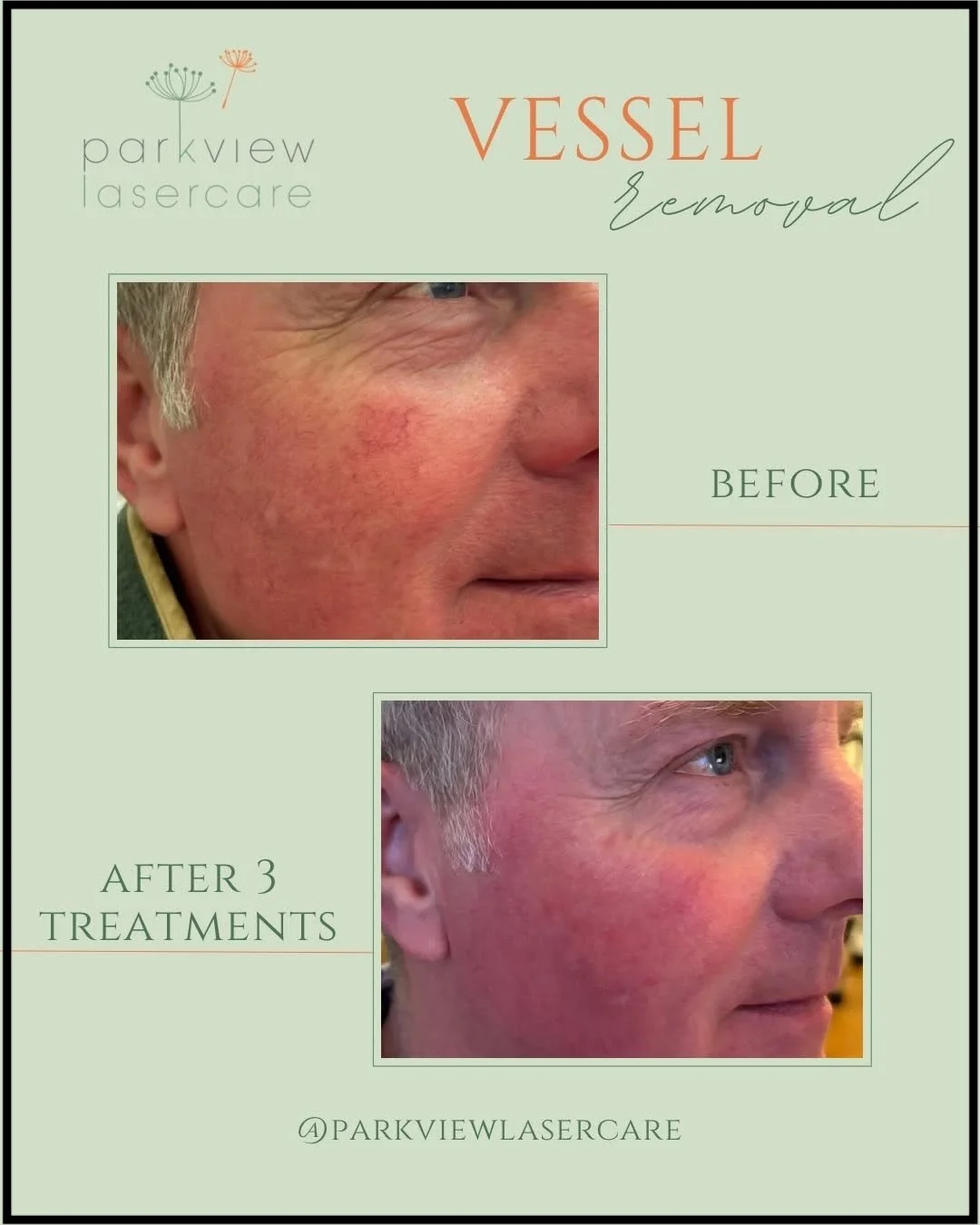 Before and after images showing the results of vessel removal treatment by Parkview Lasercare. The before photo shows redness and visible blood vessels on a man's cheek; the after photo shows clearer skin with reduced redness.