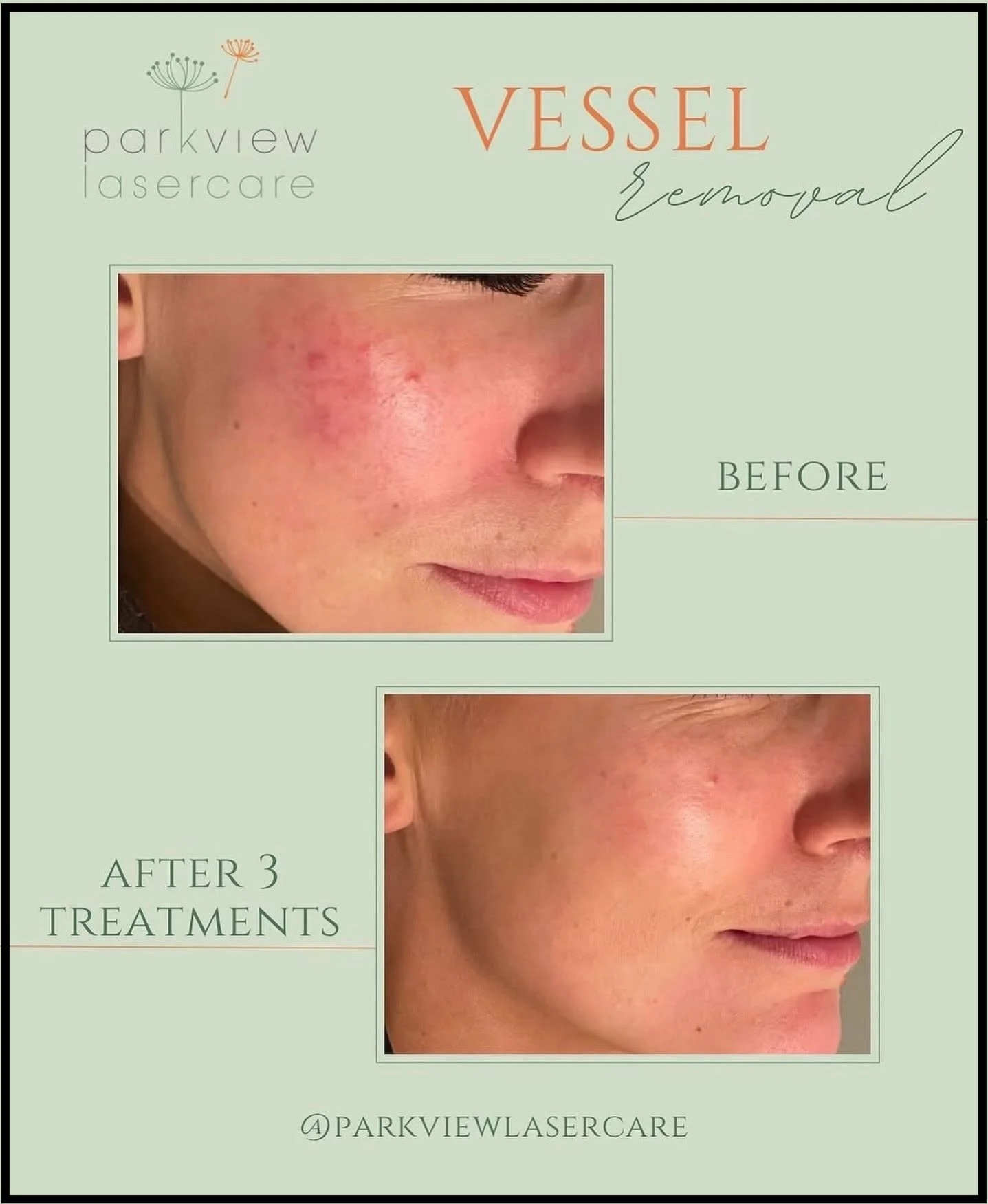Before and after images showing skin improvement after three treatments at Parkview Lasercare.