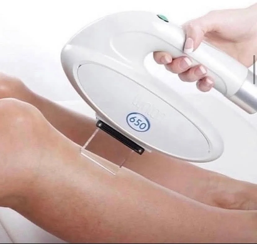 back leg of client being treated for hair removal with lynton laser handset