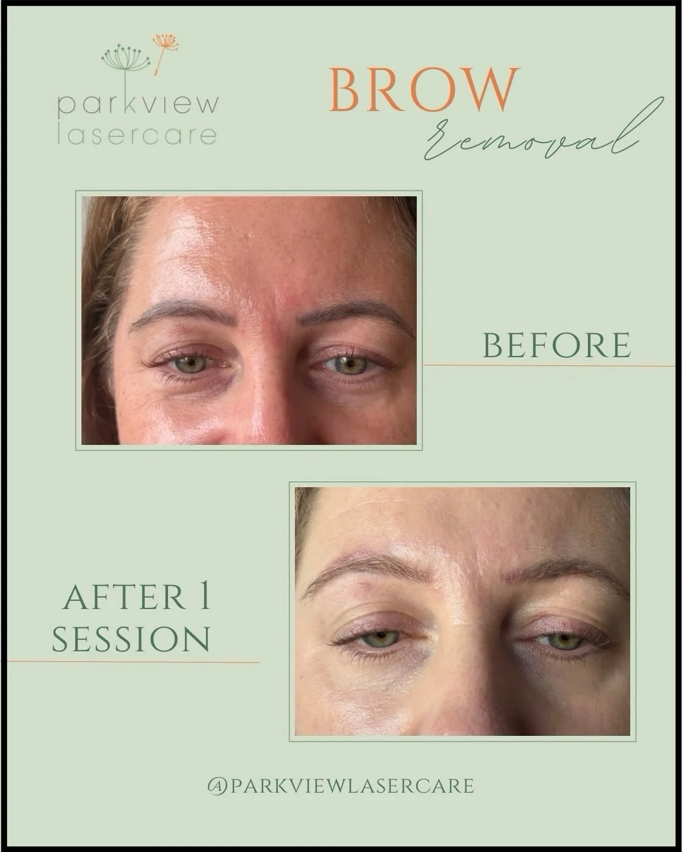 Before and after images showing the successful results of eyebrow removal treatment at Parkview Lasercare.