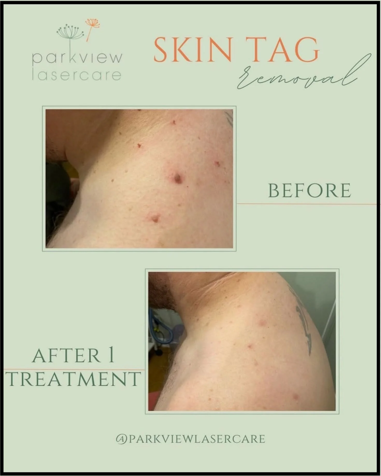 Before and after images showing the shoulder area of a person who underwent skin tag removal treatment at Parkview Lasercare, showing reduction in skin tags after 1 session.