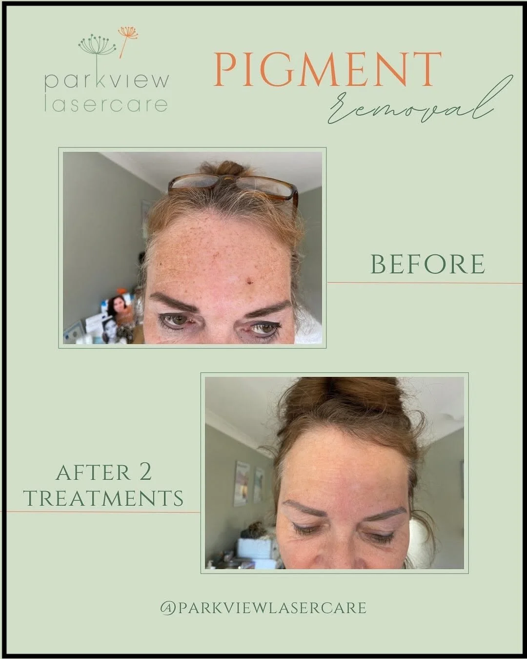 Before and after images showing the removal of pigmentation spots from a woman's forehead, as a result of successful treatment at Parkview Lasercare.