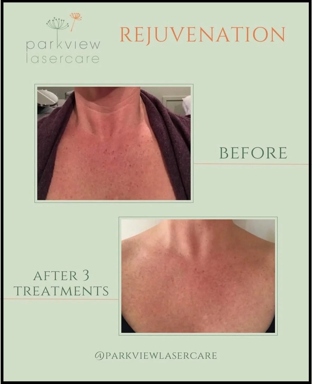 Before and after images of a woman's neck showing skin improvement after three laser treatments at Parkview Lasercare.