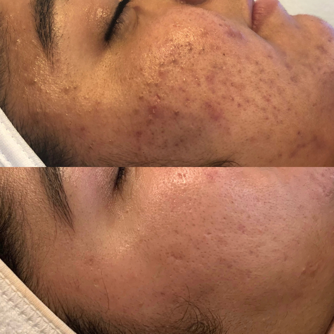 acne-correction-berkeley-ca