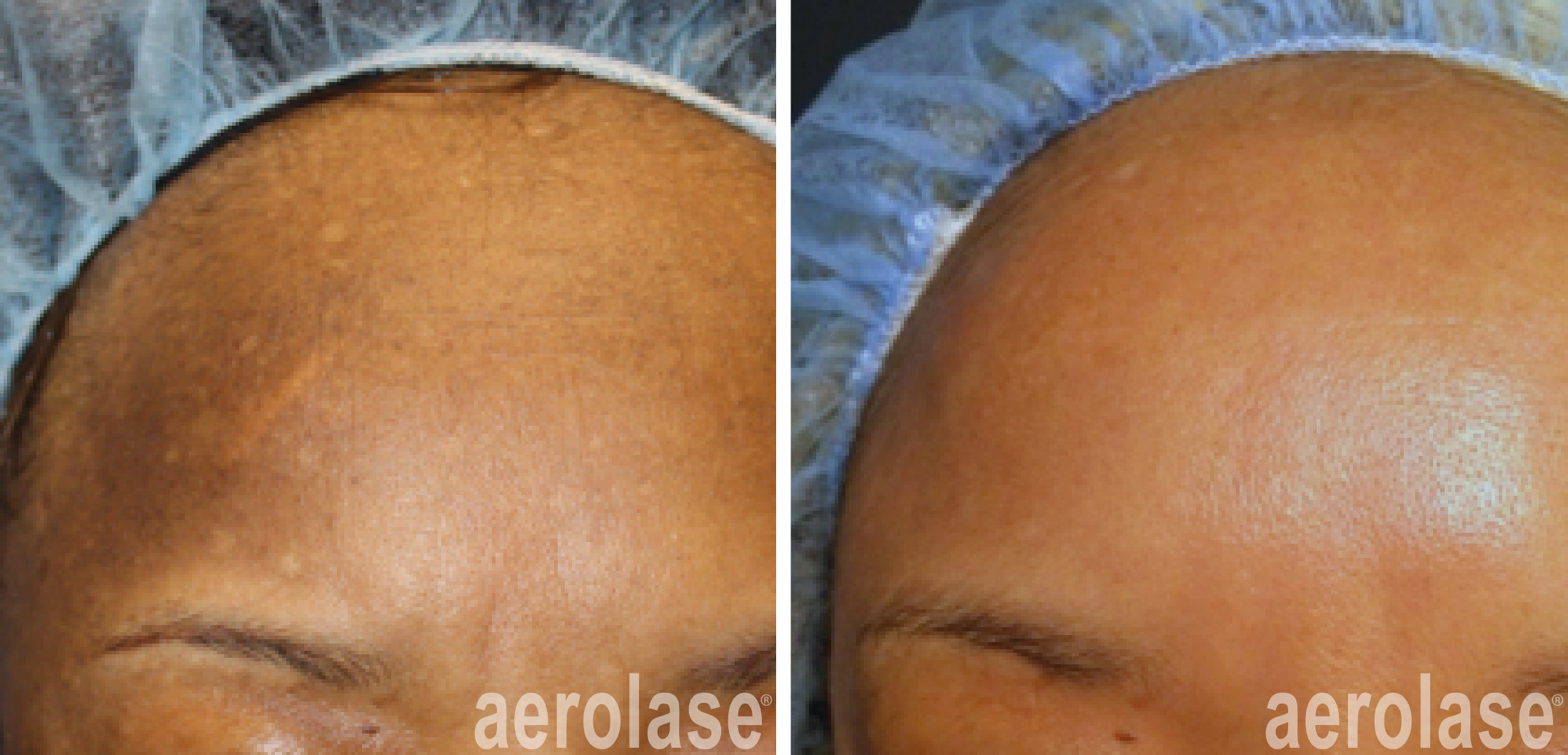 aerolase-melasma-before-after-cheryl-burgess-1-treatment.png