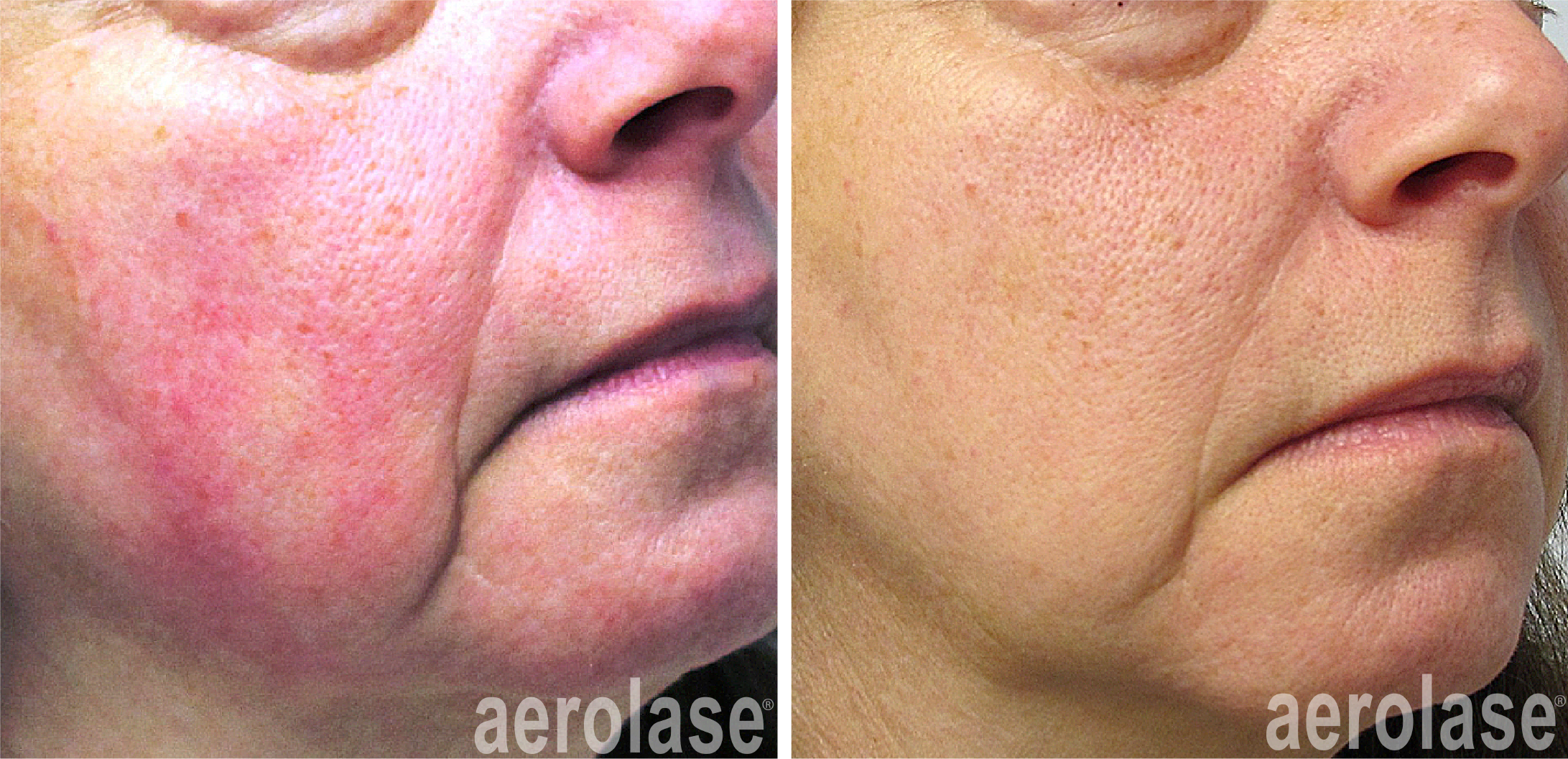 aerolase-rosacea-yelena-kipervas-1-treatment.png