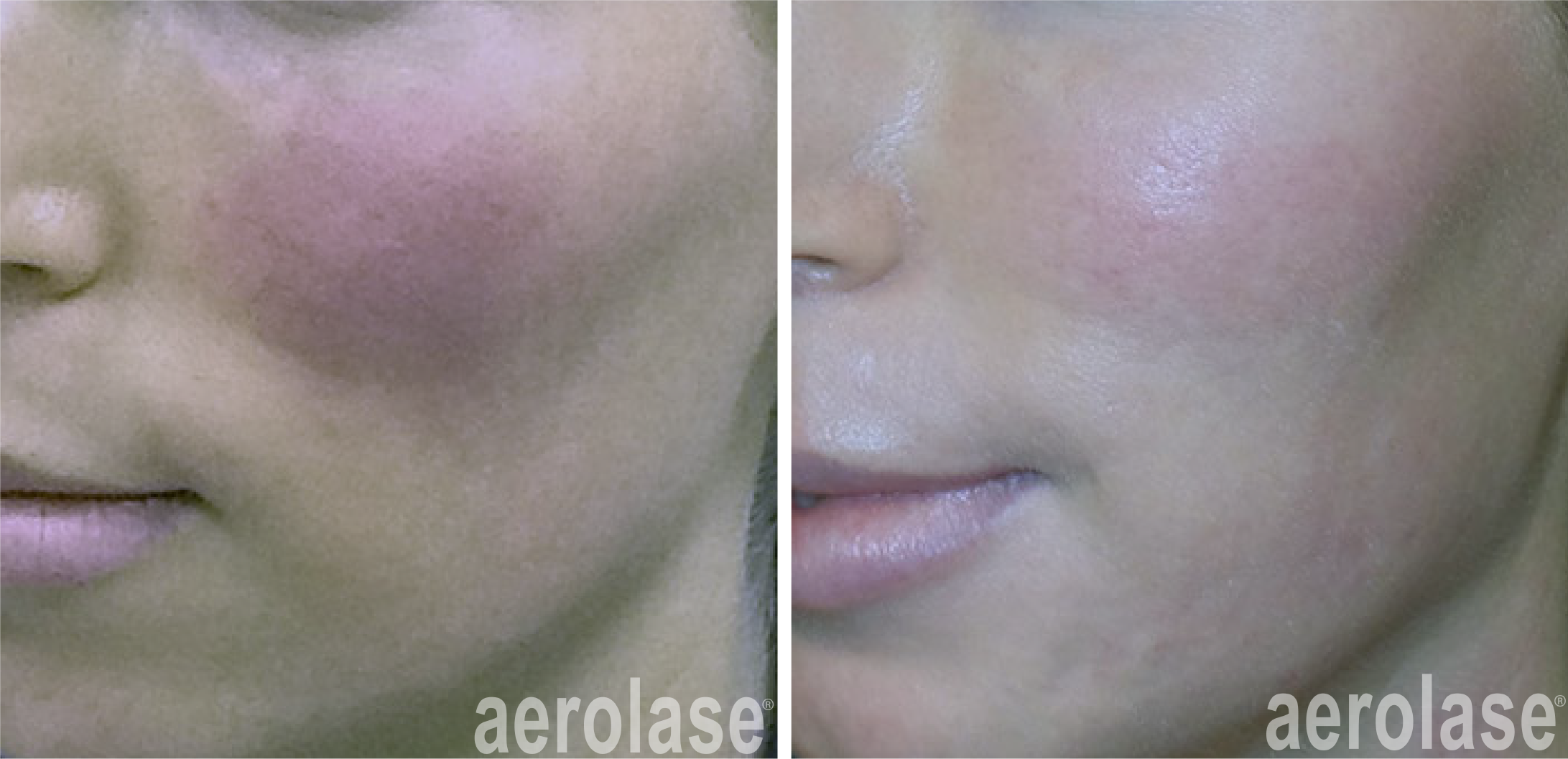 aerolase-neoskin-rosacea-kevin-pinski-after-1-treatment.png