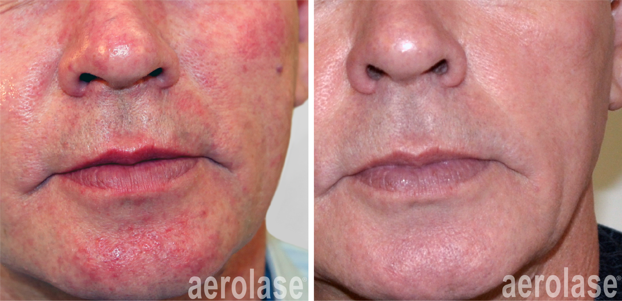 aerolase-neoskin+Rosacea+-+After+2+Treatments+-+Natalia+Geraskova+MD.png