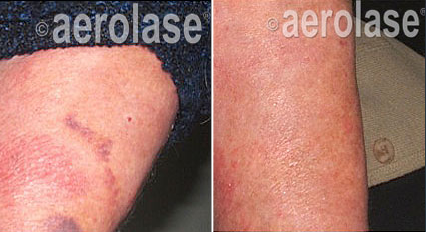 Psoriasis2+-+Pair.png