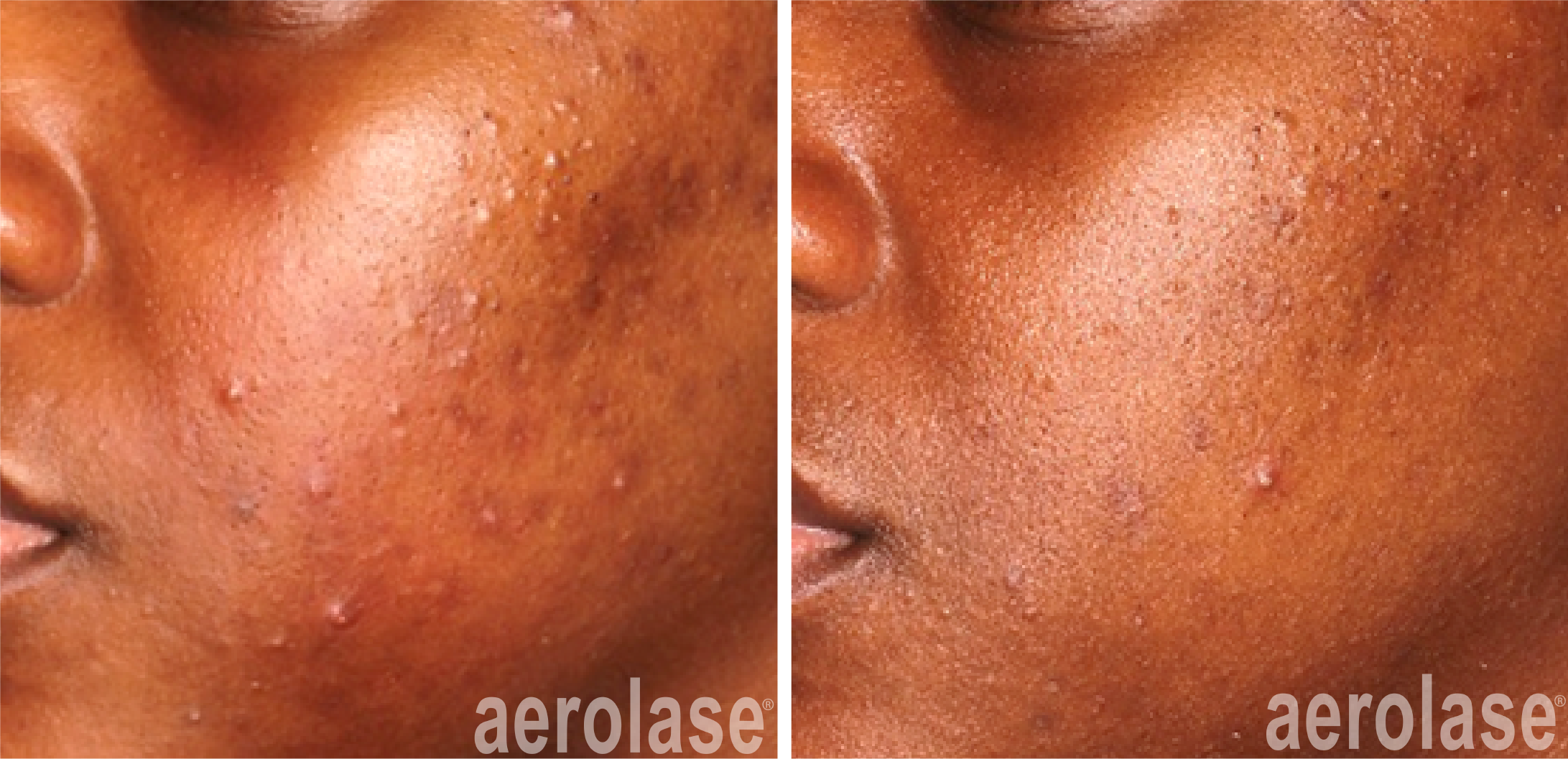 aerolase-before-after-michelle-henry-4-treatments+(1).png