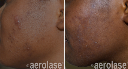 Acne5+-+Pair.png
