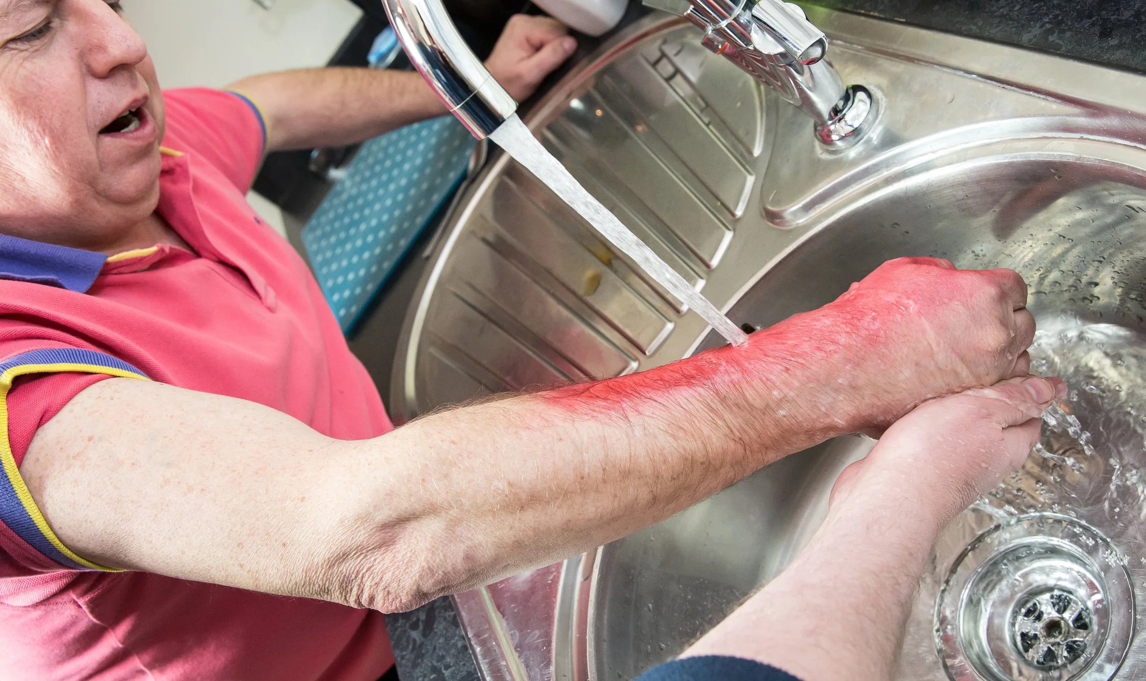 Don't Use Butter! How to Safely Treat Burns.