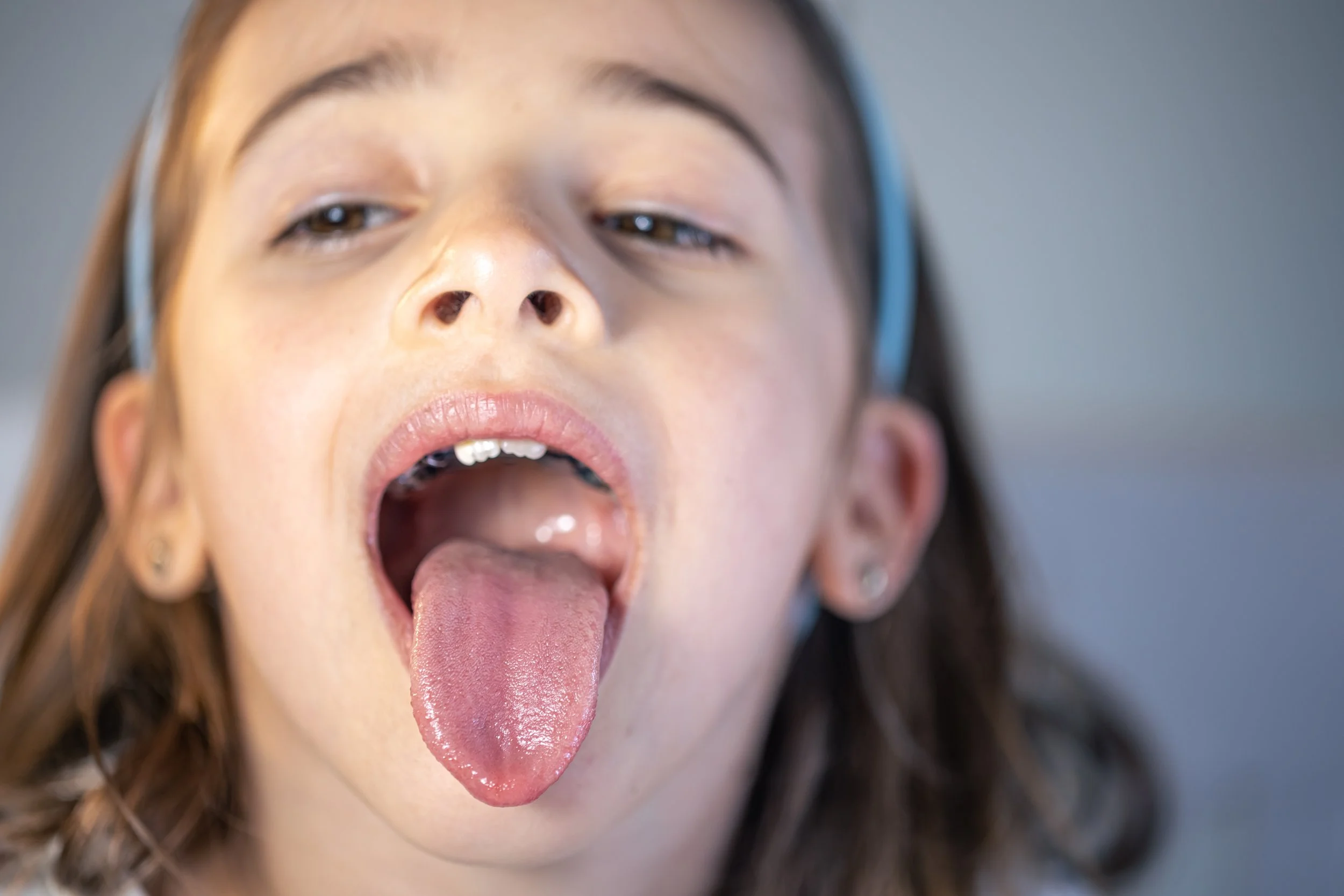 How Tongue-Tie (Ankyloglossia) Affects Breathing, Speech & Oral Development