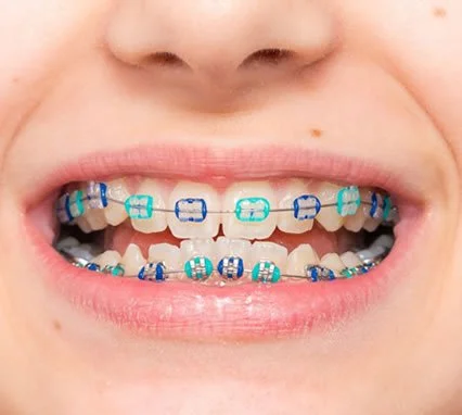 Smiling teeth with braces