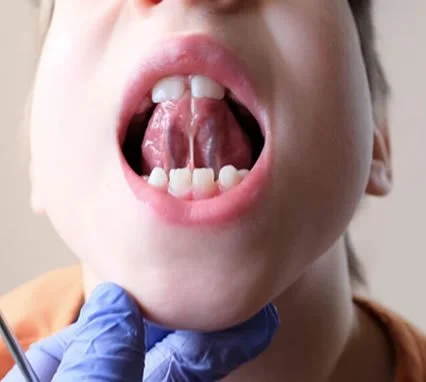 Child with a tongue tie lifting their tongue