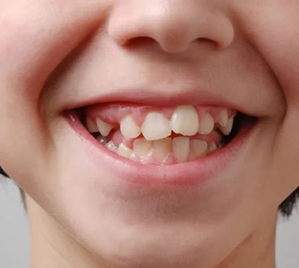 Smiling child with crowded teeth