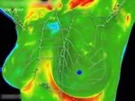 Breast Study