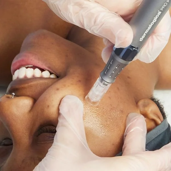 LuminFusion Facial