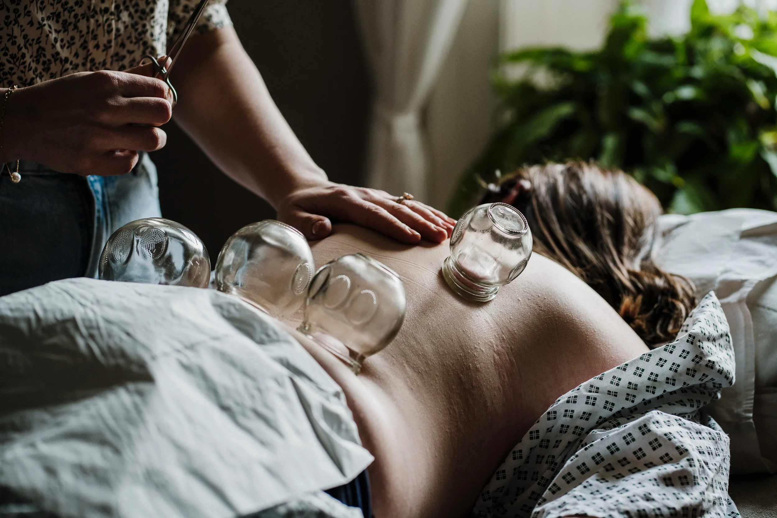 A person receiving cupping therapy on their back with several glass cups, while lying on a hospital bed in a medical setting.