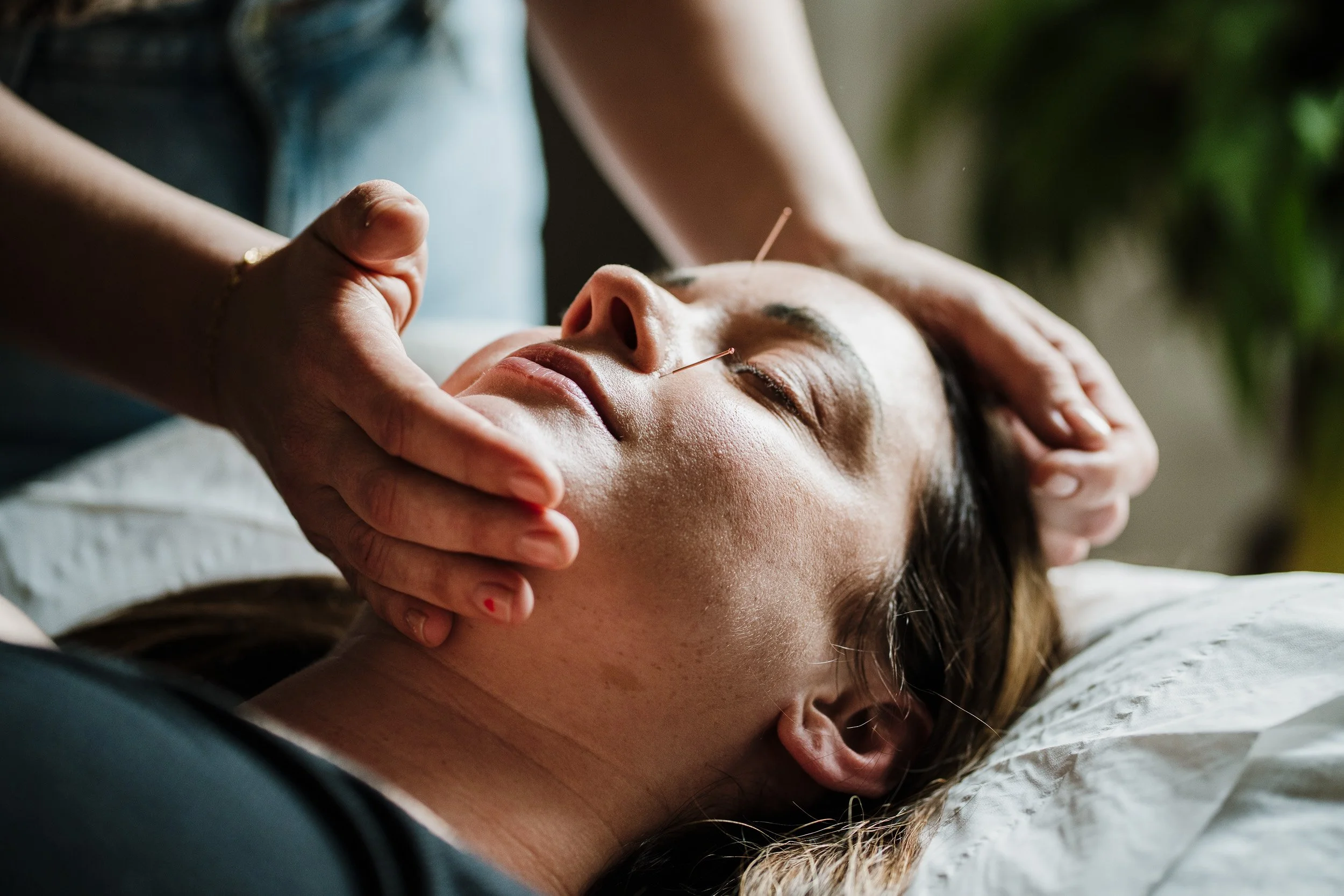 Person receiving facial acupuncture, lying on treatment bed with needles inserted around face and head, in a relaxing spa setting.