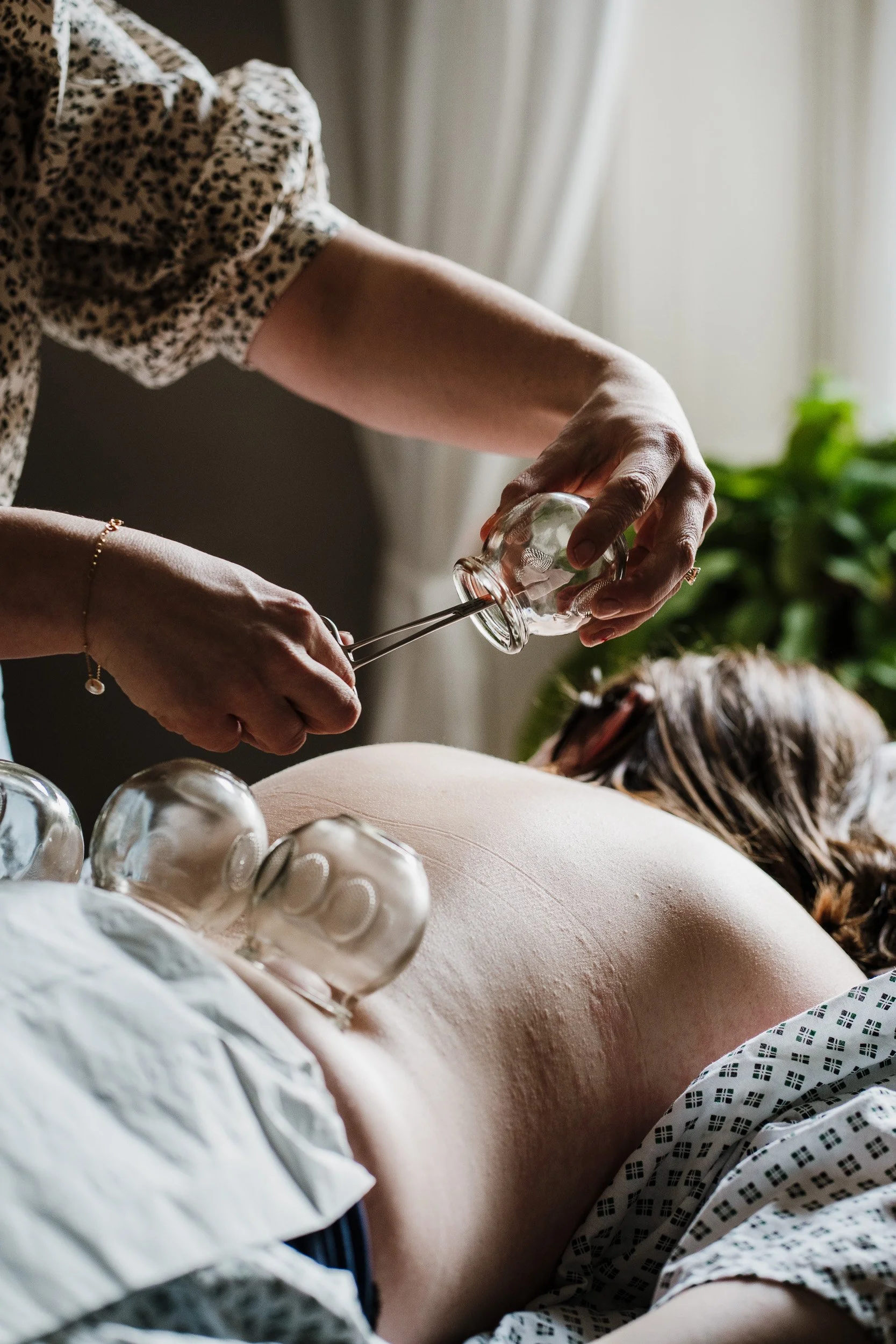 A person is receiving a cupping therapy treatment, with glass cups placed on their back as part of a traditional healing practice.