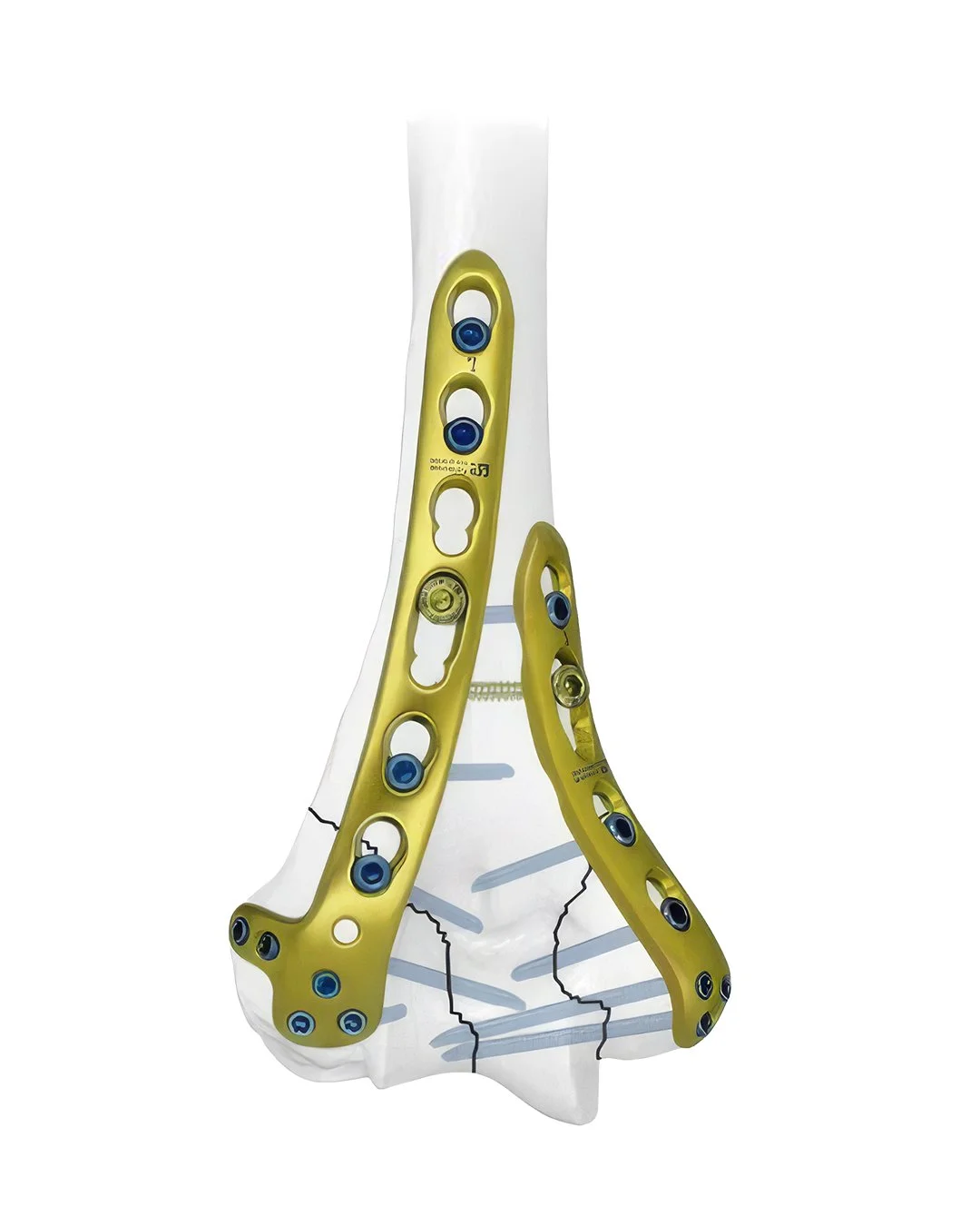 Set de Placas de Bloqueo Humeral Distal