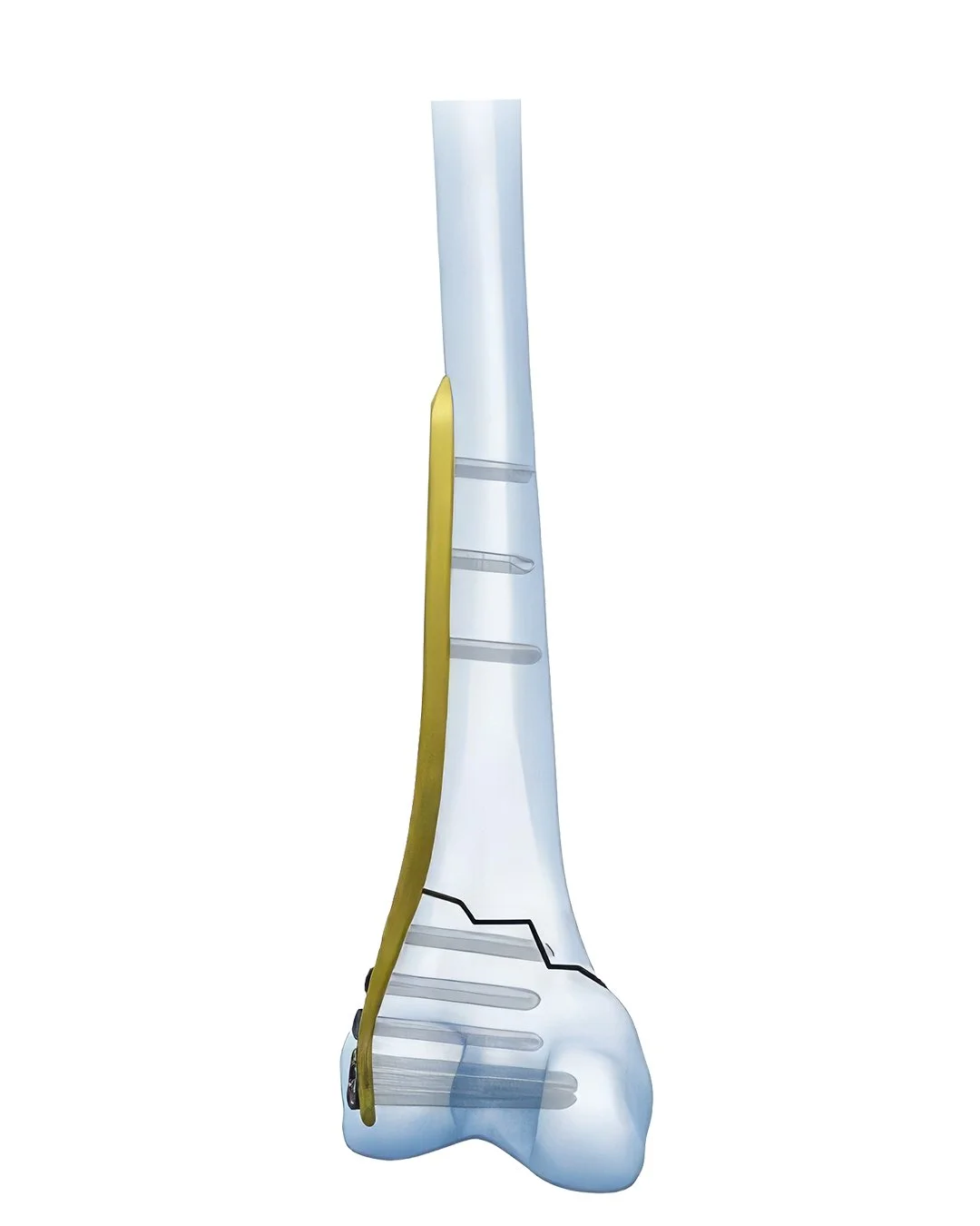 Placa-Anatómica-de-Bloqueo-Femoral-Distal-Doble-Orificio2.jpg