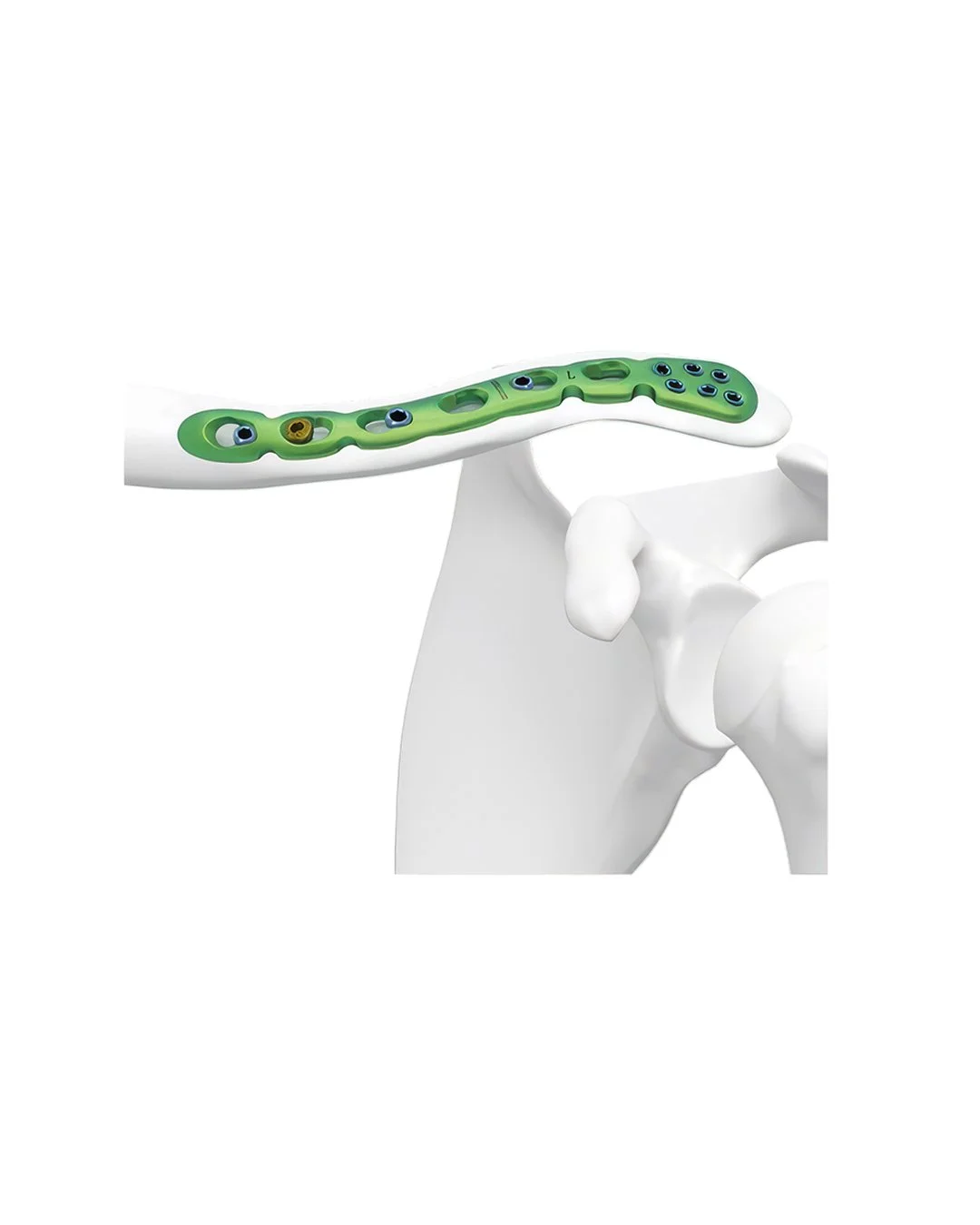 Placa de Bloqueo para clavícula distal anterior superior.