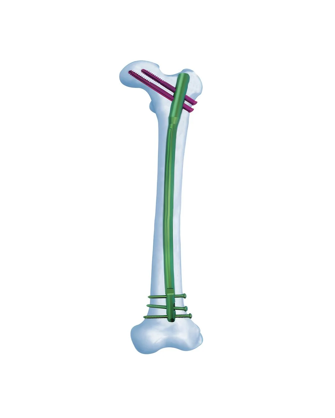 Clavo Femoral Universal II UFN II Expert de Reconstrucción