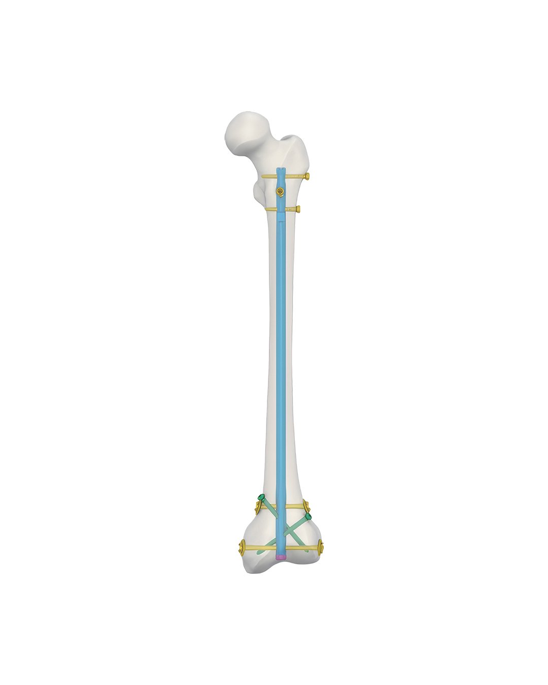 Clavo-Femoral-Retrógrado.jpg