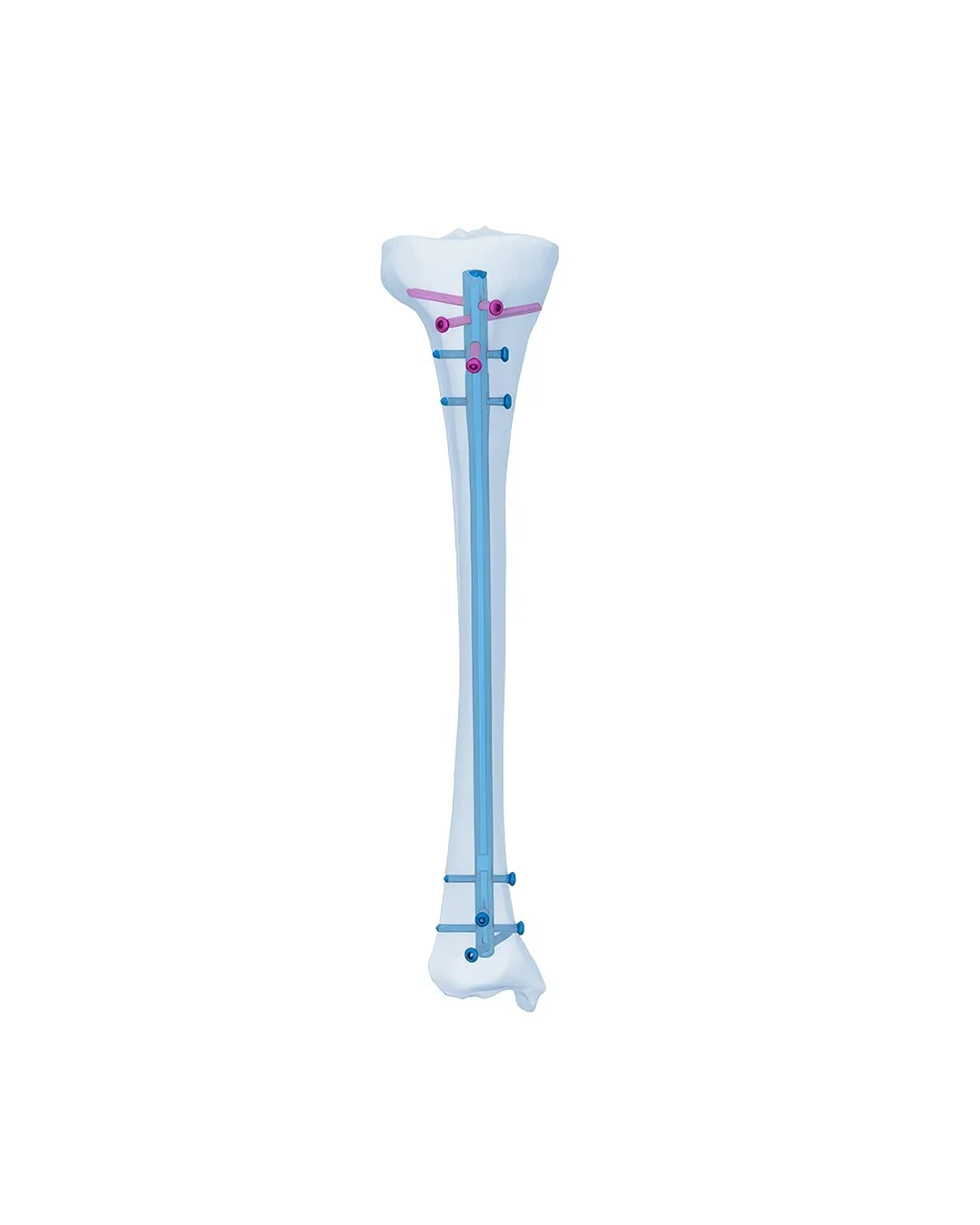 Clavo-Tibial-Universal-II-(UTN-II)-Expert.jpg