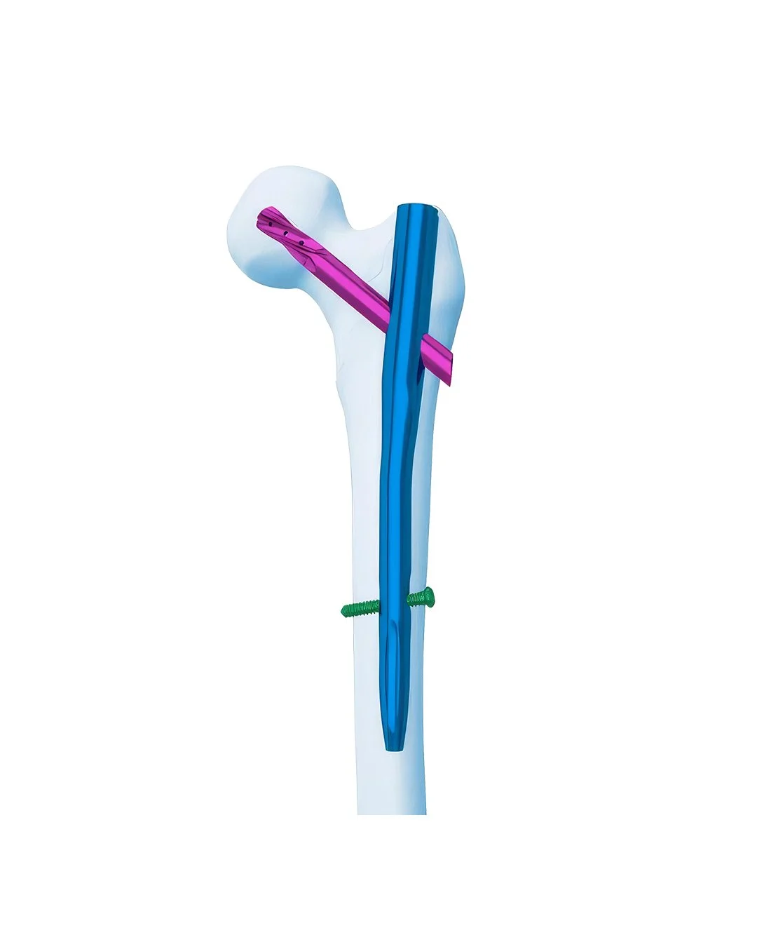 Clavo-Femoral-Proximal-Aimstrong-(APFN).jpg