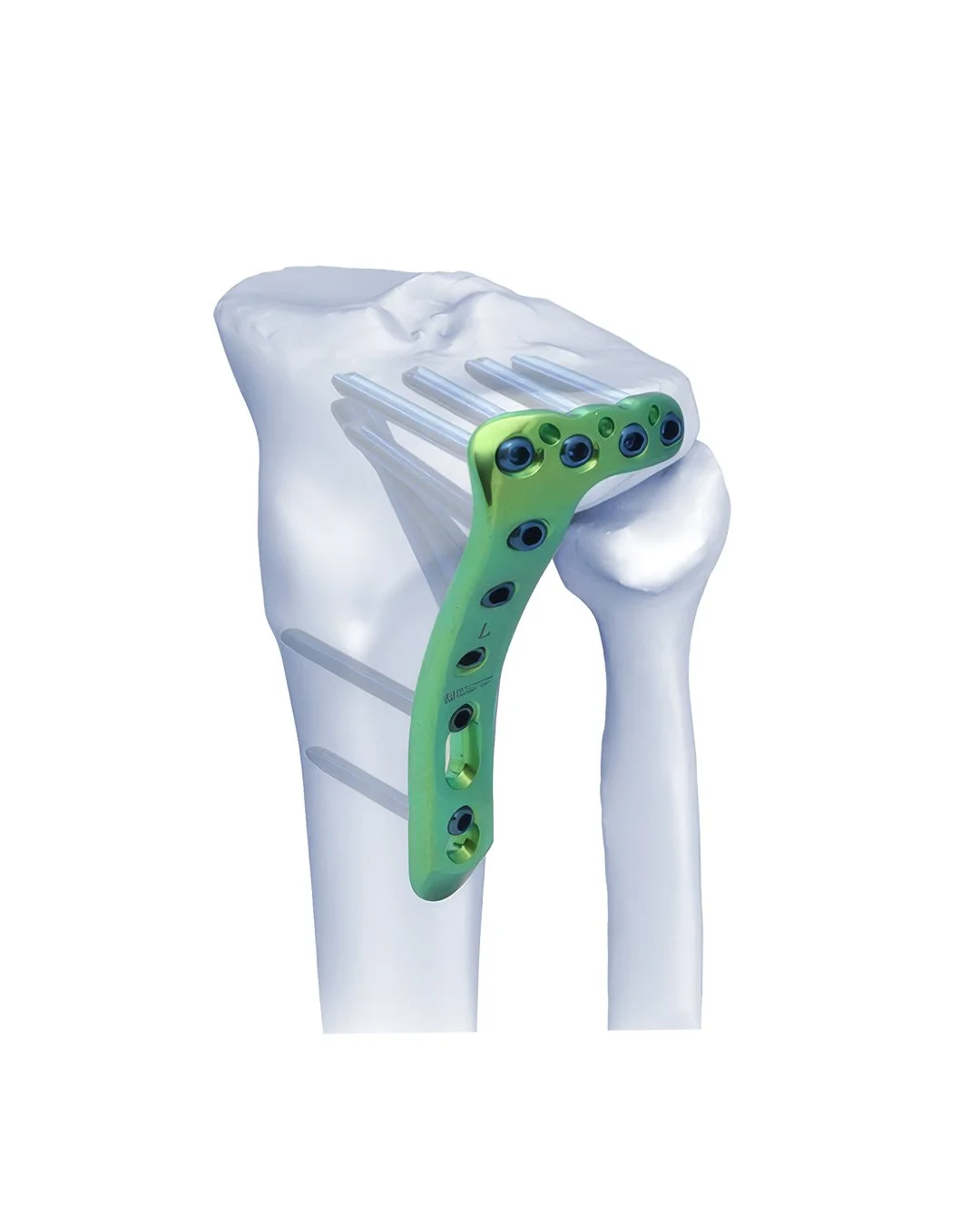 Placa Anatómica de Bloqueo Tibial Lateral Proximal