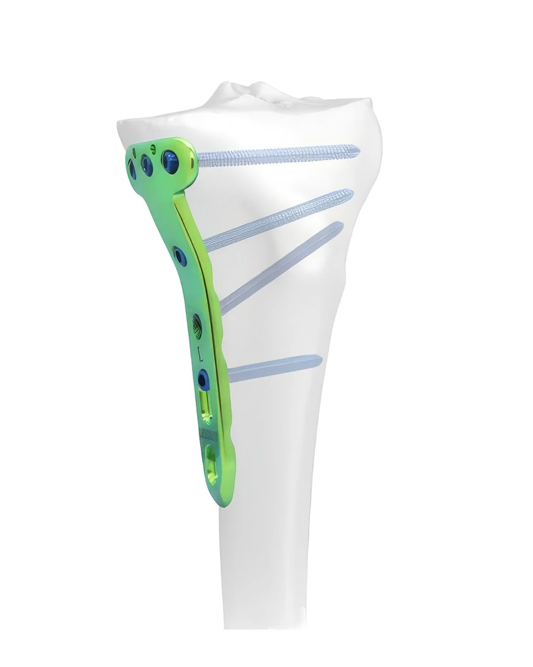 Placa de Bloqueo Tibial Medial Proximal