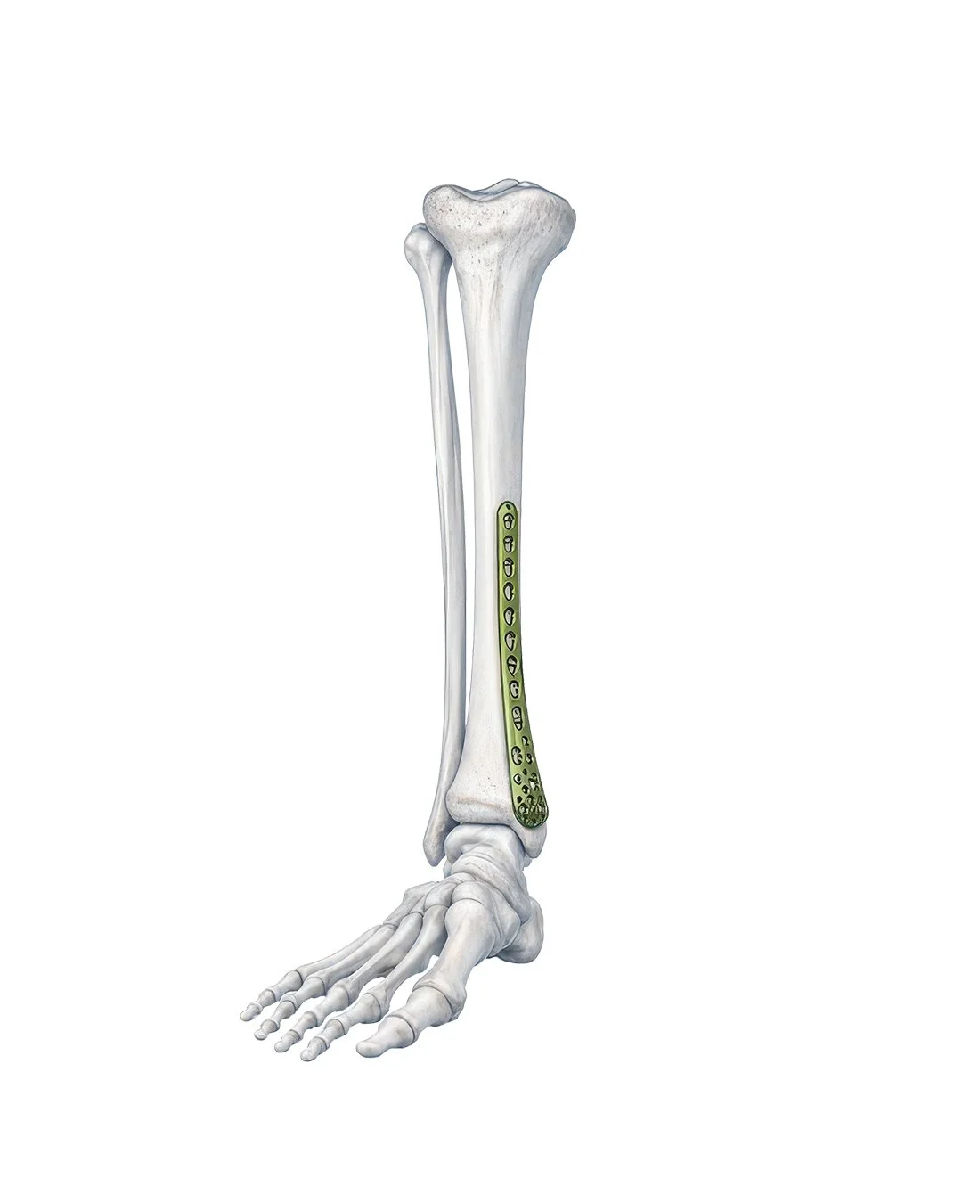 Placa-de-Bloqueo-deTibial-Distal-Medial.jpg