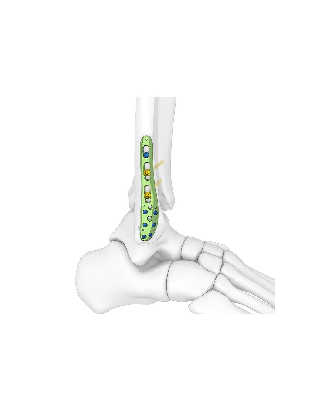 Placa-Distal-Lateral-Fibular-Bloqueada.jpg