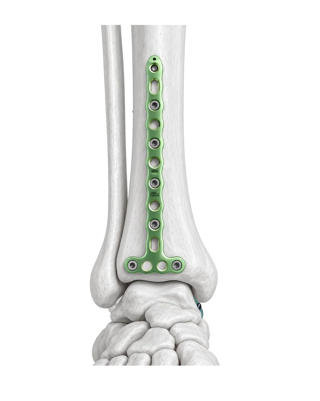 Placa de Bloq. MD Tibia Distal Anterior en T 3,5
