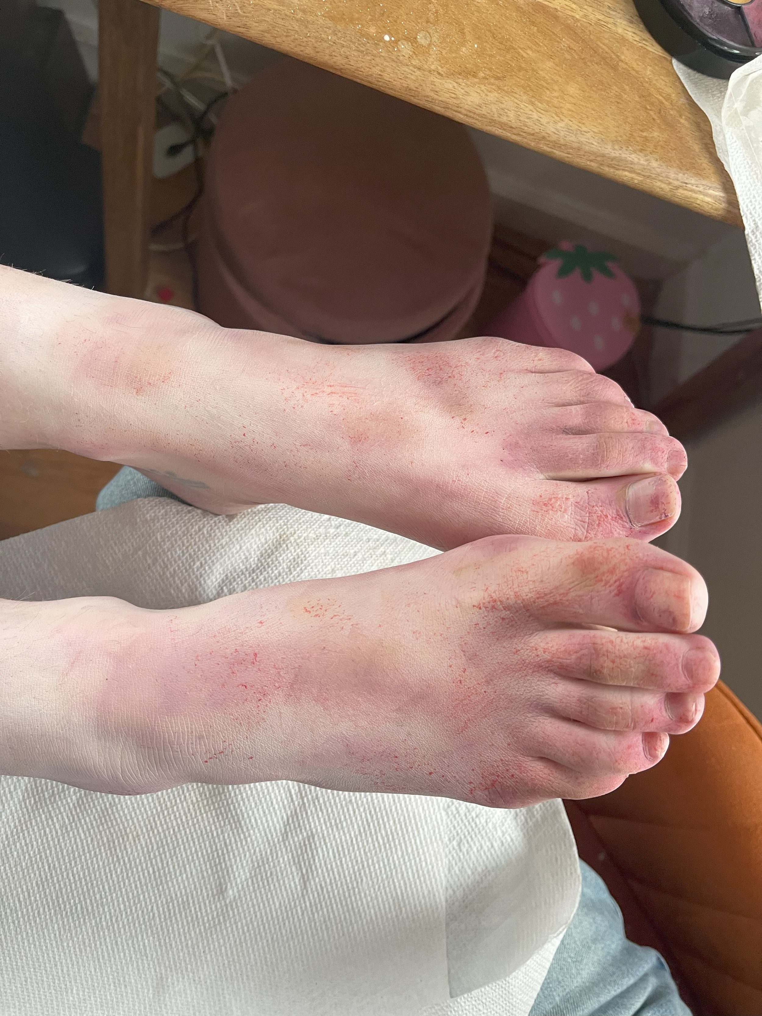 Two light-skinned hands resting on a white cloth, with visible redness and irritation on the skin. A wooden table or desk is in the background with a pink container and other objects.
