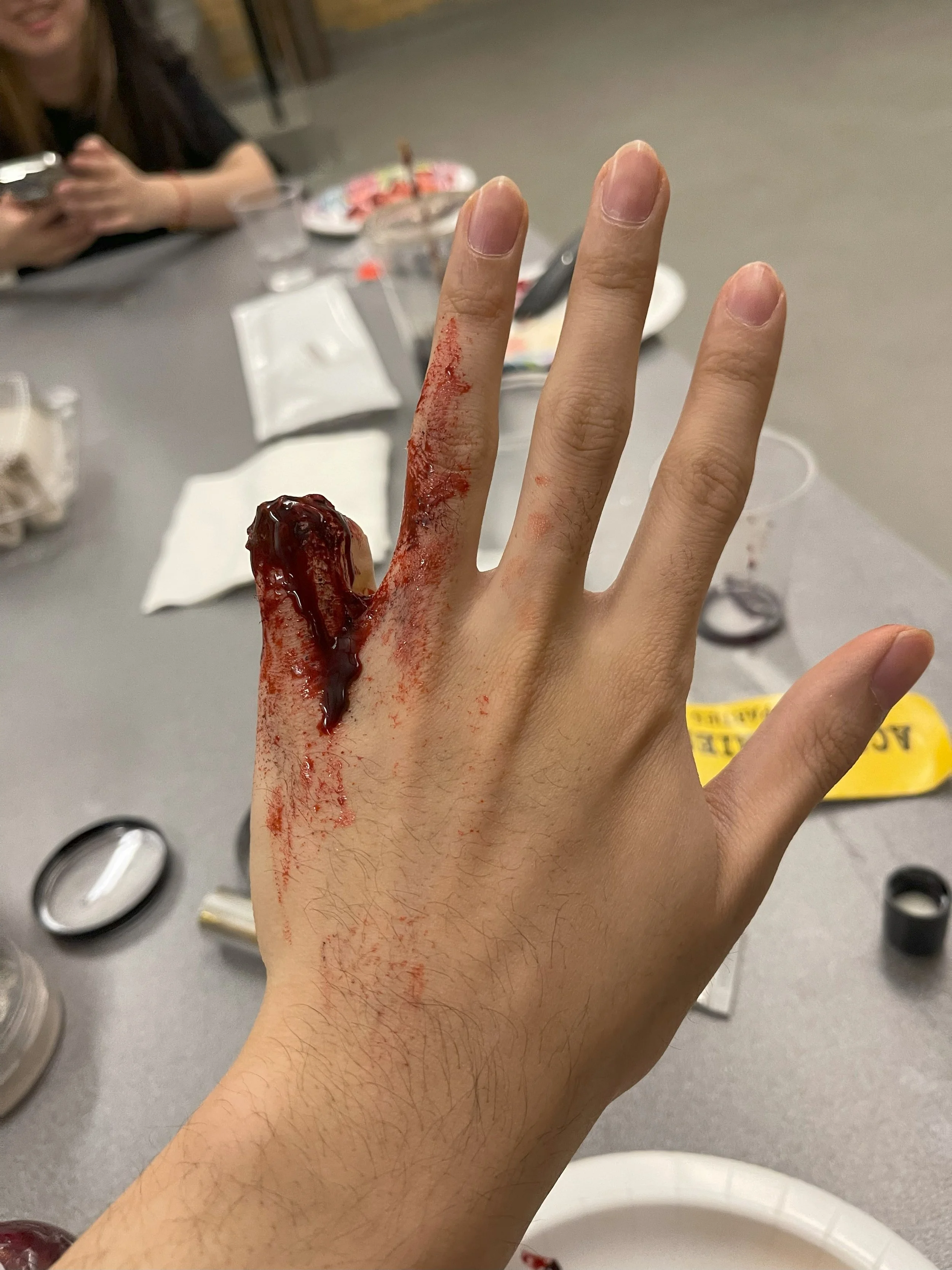 Close-up of a person's hand with blood and a large wound on the middle finger, in a medical or emergency setting.