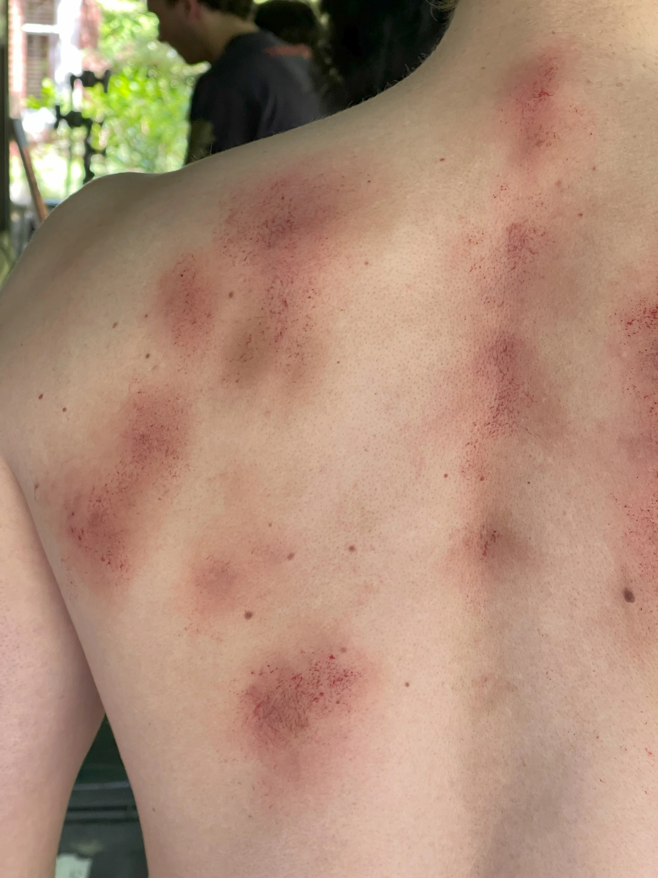 Close-up of a person's shoulder and back with multiple red, irritated skin patches, possibly from a rash or skin reaction.