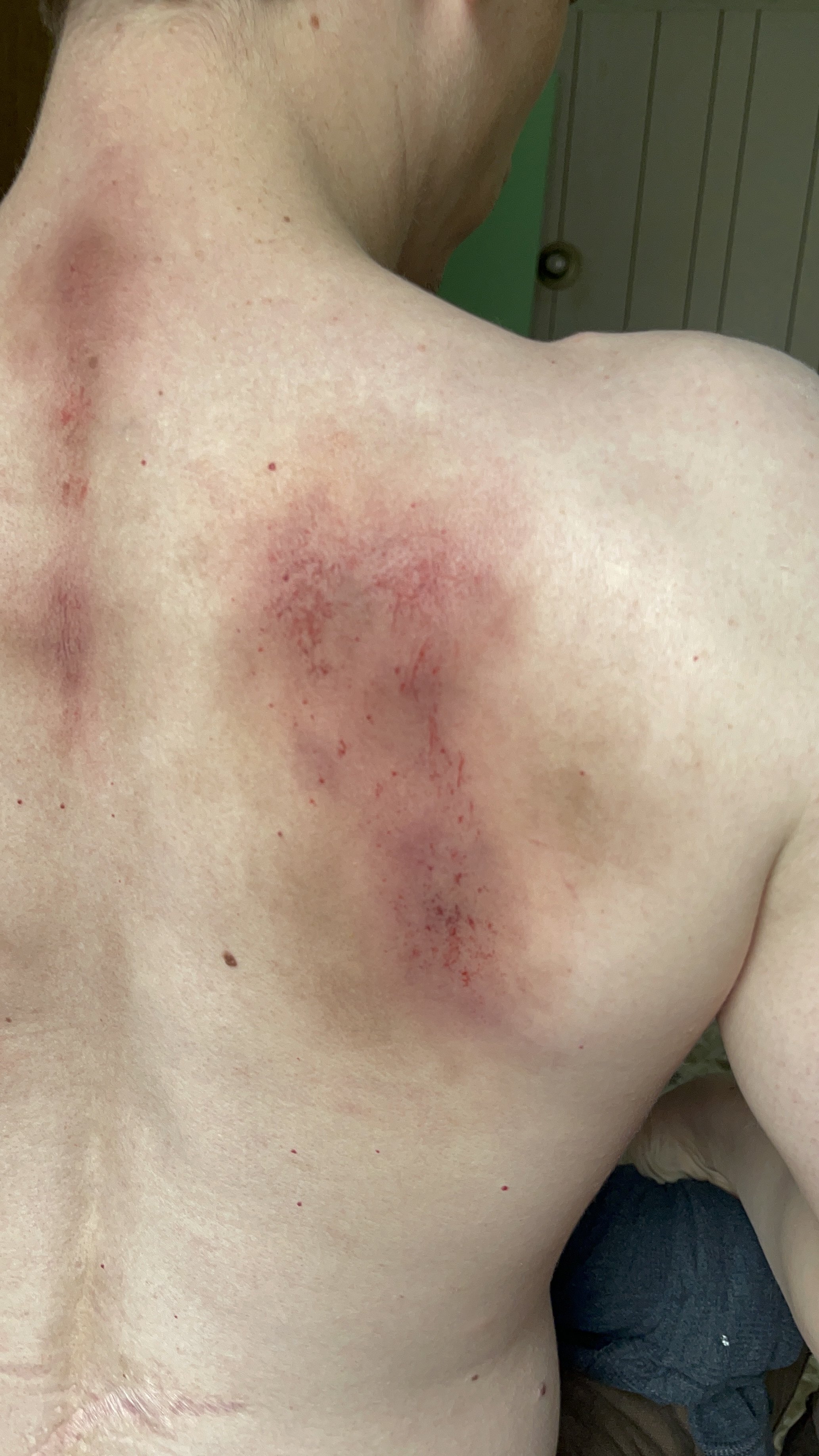A person's upper shoulder and chest area with visible redness, irritation, and some small red spots. The background shows part of a door and a person's clothing.